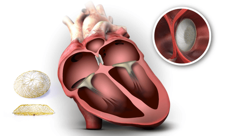 ASD, VSD & PDA Closure