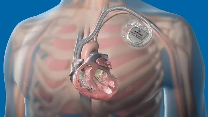 ICD & CRTD Implantation