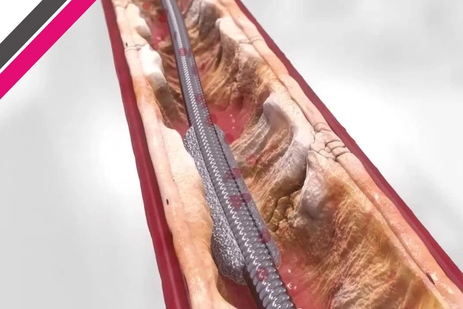Orbital Atherectomy