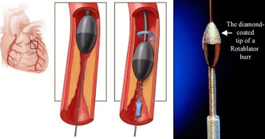 Rota-ablation (Atherectomy)