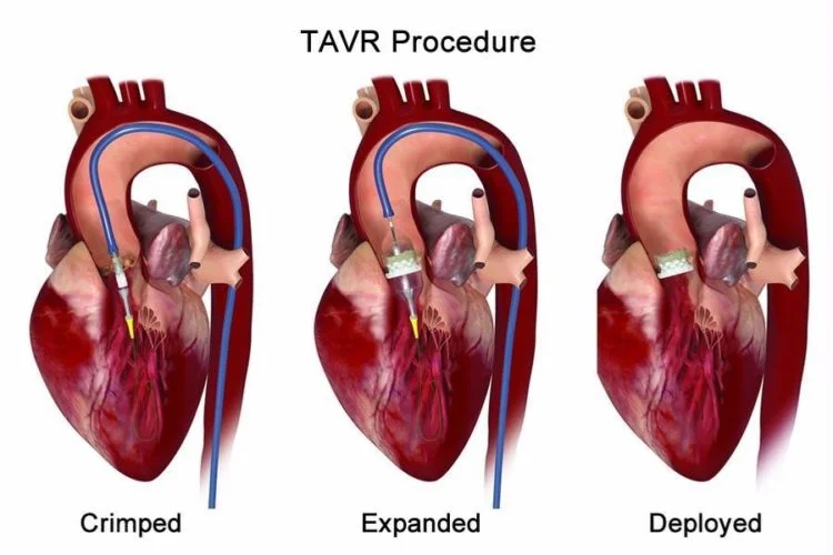 TAVI / TAVR Surgery