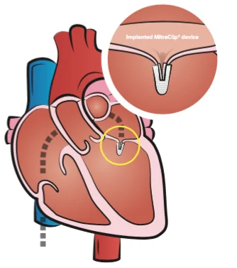 mitraclip
