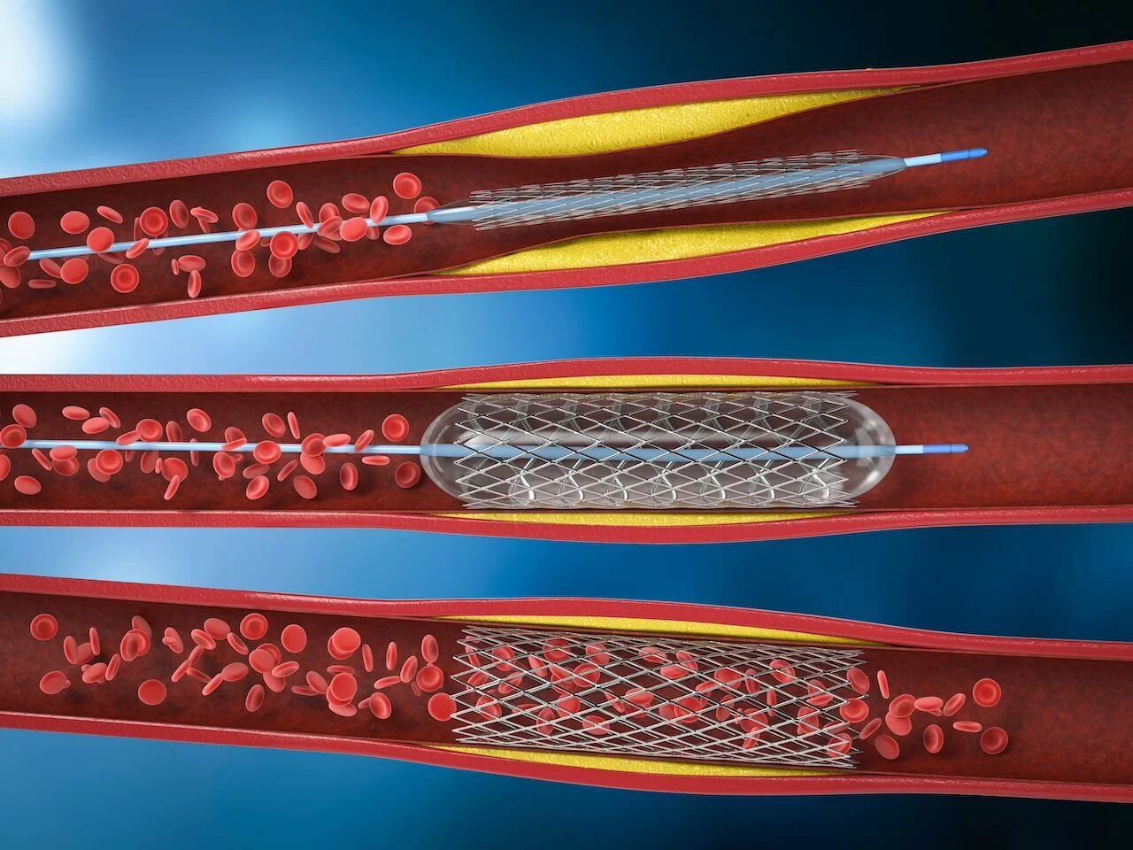 Peripheral Angioplasty